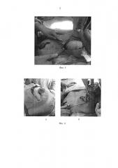 Способ реконструкции молочной железы после подкожной мастэктомии (патент 2653803)