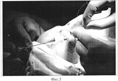 Способ хирургического лечения птоза верхнего века с отсутствием функции леватора у детей (патент 2553944)