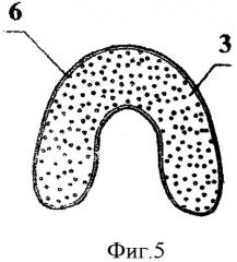 Съемный протез куретовых на беззубую нижнюю и верхнюю челюсти с посадочным местом для альвеолярного гребня и твердого неба (патент 2462211)