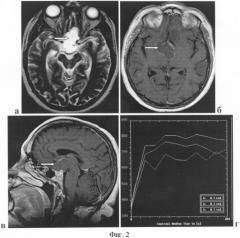 Способ диагностики кистозных опухолей хиазмально-селлярной области (патент 2352246)