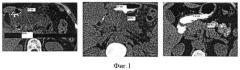Способ динамической оценки структурных изменений паренхимы поджелудочной железы (патент 2501527)