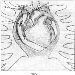 Способ маммарокоронарного шунтирования правой коронарной артерии у больных ишемической болезнью сердца (патент 2407457)