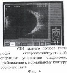 Способ склерореконструктивного лечения высокой близорукости (патент 2367394)