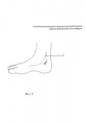 Способ функционального артродеза при диабетической нейроостеоартропатии (стопа шарко) (патент 2604383)