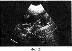Способ ультразвуковой диагностики коарктации аорты (патент 2244512)