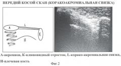 Способ ультразвуковой диагностики типа положения акромиального отростка лопатки относительно головки плечевой кости (патент 2367346)