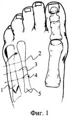 Способ фиксации пятой плюсневой кости при ее остеотомии (патент 2323696)