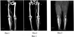 Способ мультиспиральной компьютерной томографии-флебографии вен нижних конечностей (патент 2548139)