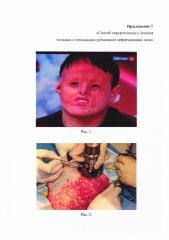 Способ хирургического лечения больных с тотальными рубцовыми деформациями лица (патент 2655832)