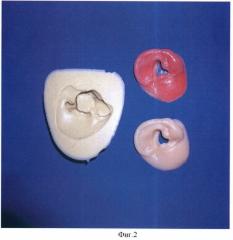 Способ изготовления челюстно-лицевых протезов (патент 2425653)