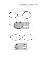 Устройство для аллопластики при паховых грыжах (патент 2578844)