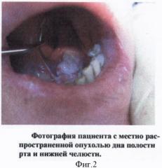 Способ функциональной реабилитации больных, перенесших операции по поводу местнораспространенных опухолей дна полости рта и нижней челюсти (патент 2371141)