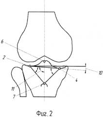 Способ дифференцированной оценки деформаций коленного сустава и выбора вида хирургического лечения при гонартрозе (патент 2498772)