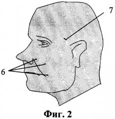 Устройство для подтяжки лица и шеи (патент 2465844)