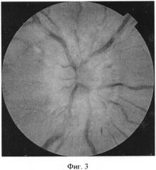 Способ диагностики новообразований зрительного нерва (патент 2553511)