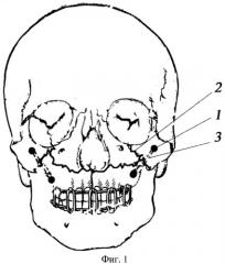 Способ остеосинтеза переломов верхней челюсти (патент 2380051)