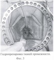 Способ маскулинизирующей уретропластики при лечении транссексуализма (патент 2371115)