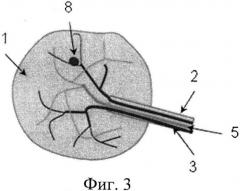 Способ моделирования артериальной аневризмы (патент 2541050)