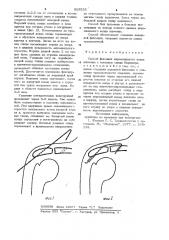 Способ фиксации акромиального конца ключицы (патент 906535)