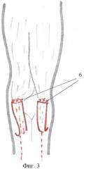 Способ лечения врожденной сгибательной контрактуры коленного сустава у детей при гипо- и аплазии сгибателей голени (патент 2423086)