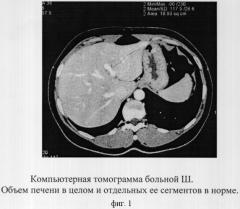 Способ компьютерно-томографической диагностики аномалий развития печени (патент 2297793)