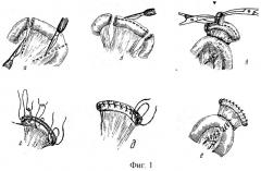 Способ пластики гепатикохоледоха трубчатым тонкокишечным трансплантатом (патент 2249434)
