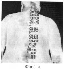 Способ определения патологии позвоночника (патент 2405417)