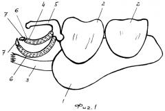 Бюгельный протез (патент 2252727)