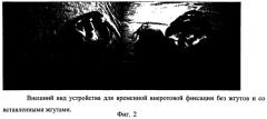 Способ изготовления шины для внеротовой временной фиксации отломков при переломах верхней и нижней челюстей (патент 2512957)