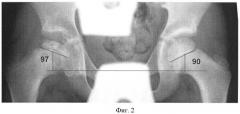Способ оценки подвывиха головки бедра при болезни легг-кальве-пертеса (патент 2436509)