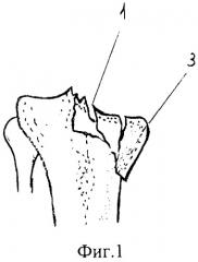 Способ лечения оскольчатых компрессионных внутрисуставных переломов метаэпифизов трубчатых костей (патент 2302213)