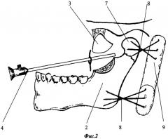 Метод внутриротового остеосинтеза под видеоэндоскопическим контролем при переломах мыщелкового отростка нижней челюсти с вывихом головки в подвисочную ямку (патент 2311143)