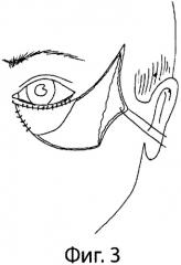 Способ закрытия обширных дефектов кожи век, распространяющихся на область наружного угла глаза и окружающие зоны лица (патент 2305519)