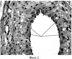 Способ реконструкции магистральных артериальных сосудов при их атеросклеротическом поражении (патент 2311139)