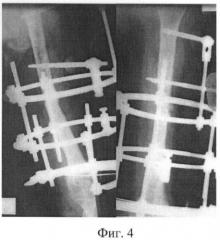 Способ лечения несросшихся переломов и ложных суставов длинных костей (патент 2383309)