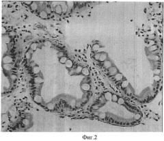 Способ лечения helicobacter pylori ассоциированной хронической язвенной болезни желудка и двенадцатиперстной кишки (патент 2416408)