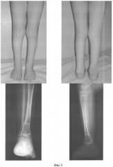 Способ лечения косолапости с внутренней торсией костей голени у детей с трехлетнего возраста (патент 2346662)