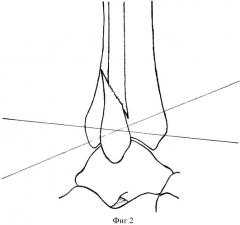 Способ репозиции наружной лодыжки при оперативном лечении застарелых повреждений голеностопного сустава (патент 2403881)