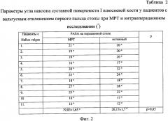 Способ определения наклона суставной поверхности головки первой плюсневой кости стопы (патент 2567825)