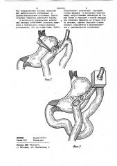 Способ лечения послеожогового стеноза пищевода и желудка (патент 1093326)