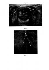 Способ диагностики ларингологических осложнений после операции на щитовидной железе (патент 2603824)