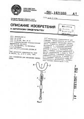 Устройство для вправления вывиха плеча (патент 1421335)