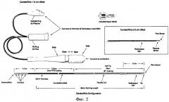 Способ интраоперационного допплерографического контроля радикальности эмболизации артерио-венозных мальформаций (патент 2511235)
