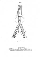 Самофиксирующийся протез кровеносного сосуда (патент 1457921)