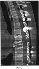 Способ сегментарной вертебротомии (патент 2573057)