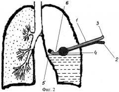 Способ фракционного дренирования плевральной полости и устройство для его осуществления (патент 2402354)