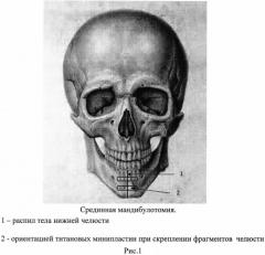 Способ хирургического лечения рака органов полости рта и ротоглотки (патент 2556604)