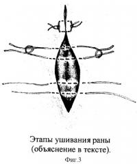Способ ушивания раны при радикальной операции по поводу эпителиального копчикового хода (патент 2305499)