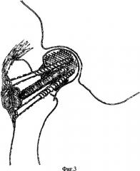 Способ лечения ложного сустава шейки и остеонекроза головки бедренной кости (патент 2328238)