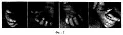 Способ улучшения вновь сформированного двухстороннего схвата при гипоплазии первого пальца кисти (патент 2515874)